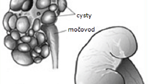 PKD - polycystick choroba ledvin